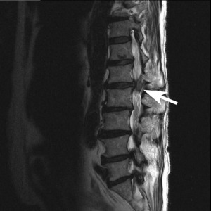 3 – Right Para-L-MRI-tagged-300×300