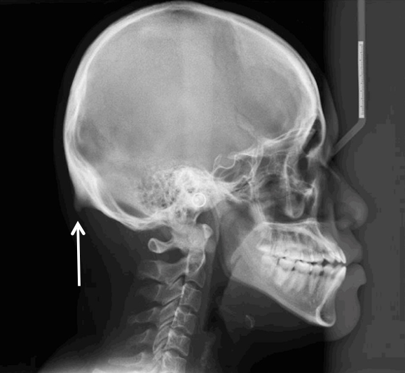 Occipital Horn Head